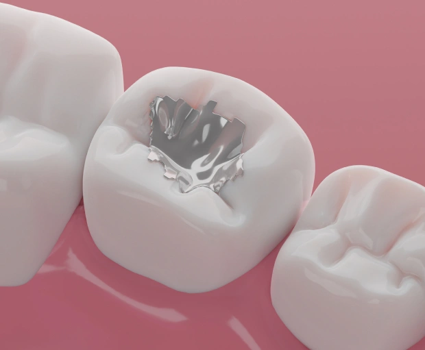 Dental Fillings