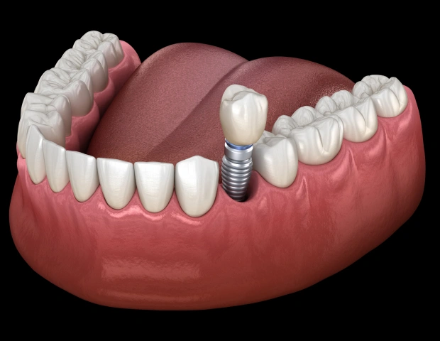Dental Implants