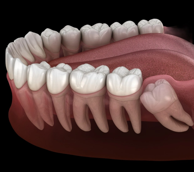 Wisdom Teeth Removal